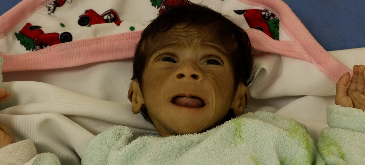 “اليونيسف”: 9 آلاف طفل دون 5 سنوات في غزة يعانون سوء تغذية حاد