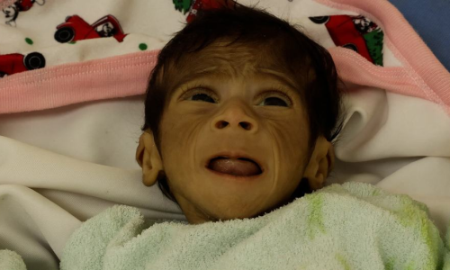 “اليونيسف”: 9 آلاف طفل دون 5 سنوات في غزة يعانون سوء تغذية حاد