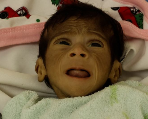 “اليونيسف”: 9 آلاف طفل دون 5 سنوات في غزة يعانون سوء تغذية حاد