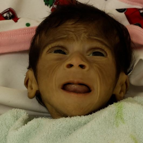 “اليونيسف”: 9 آلاف طفل دون 5 سنوات في غزة يعانون سوء تغذية حاد