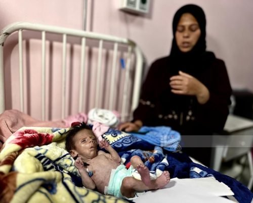 “الصحة العالمية”: 112 طفلا يدخلون مستشفيات غزة يوميا بسبب سوء التغذية