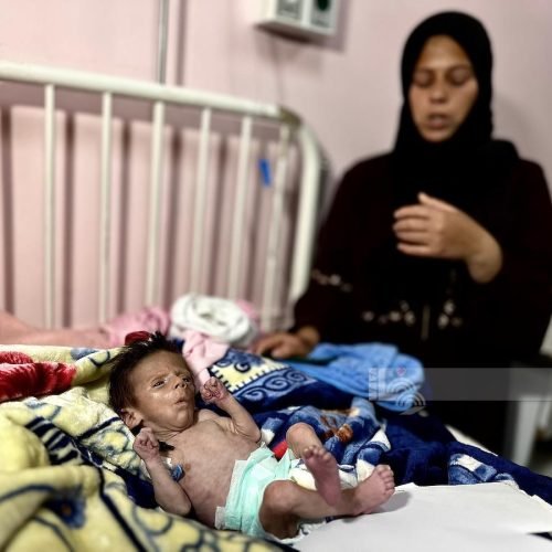 “الصحة العالمية”: 112 طفلا يدخلون مستشفيات غزة يوميا بسبب سوء التغذية