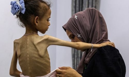 غزة: 6 وفيات جديدة بسوء التغذية بينهم طفلان والحصيلة ترتفع إلى 393