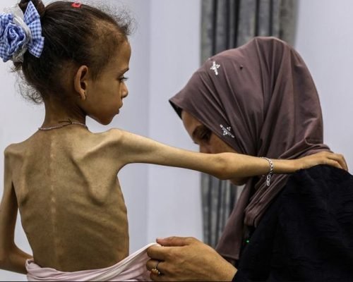 غزة: 6 وفيات جديدة بسوء التغذية بينهم طفلان والحصيلة ترتفع إلى 393