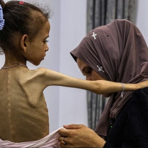 غزة: 6 وفيات جديدة بسوء التغذية بينهم طفلان والحصيلة ترتفع إلى 393